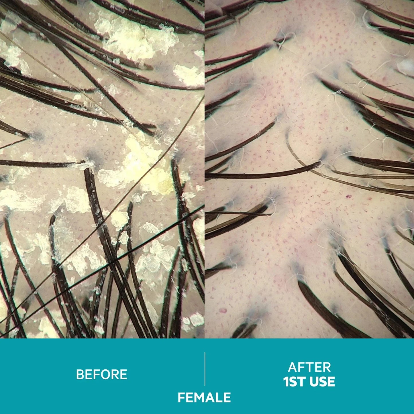 Dandrene Exfoliating Anti-Dandruff Shampoo by Monarch MD Medical Aesthetics