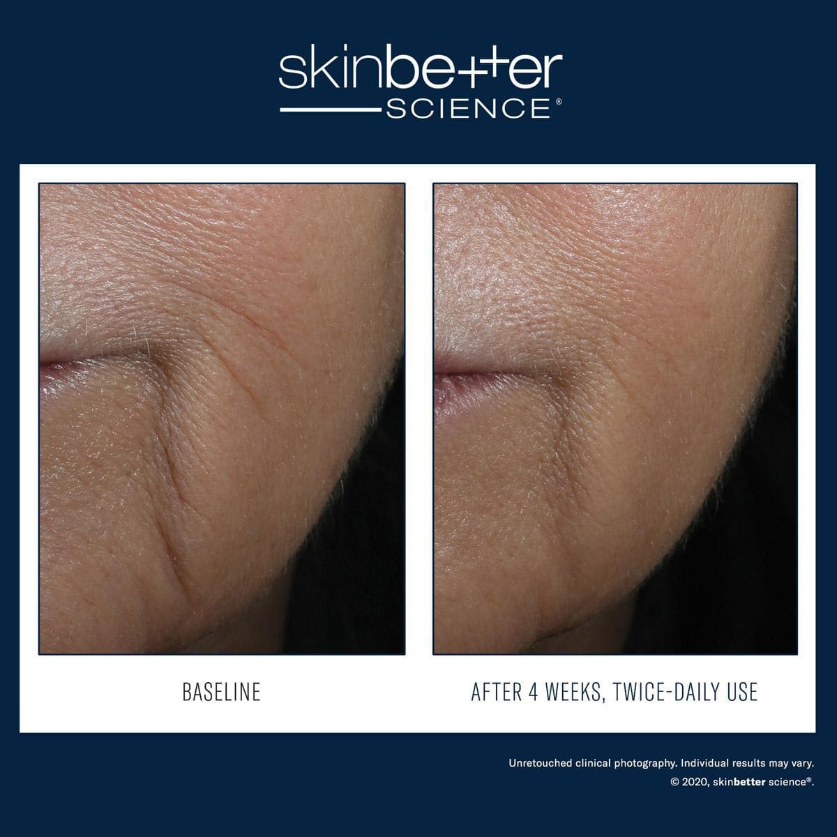 Skinbetter Science - Interfuse Intensive Treatment Lines by Monarch MD Medical Aesthetics