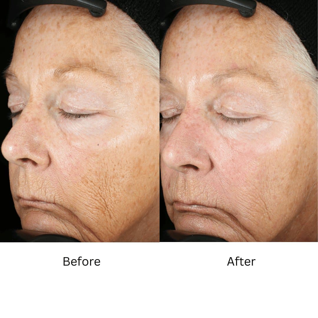 ZO Wrinkle and Texture Repair by Monarch MD Medical Aesthetics