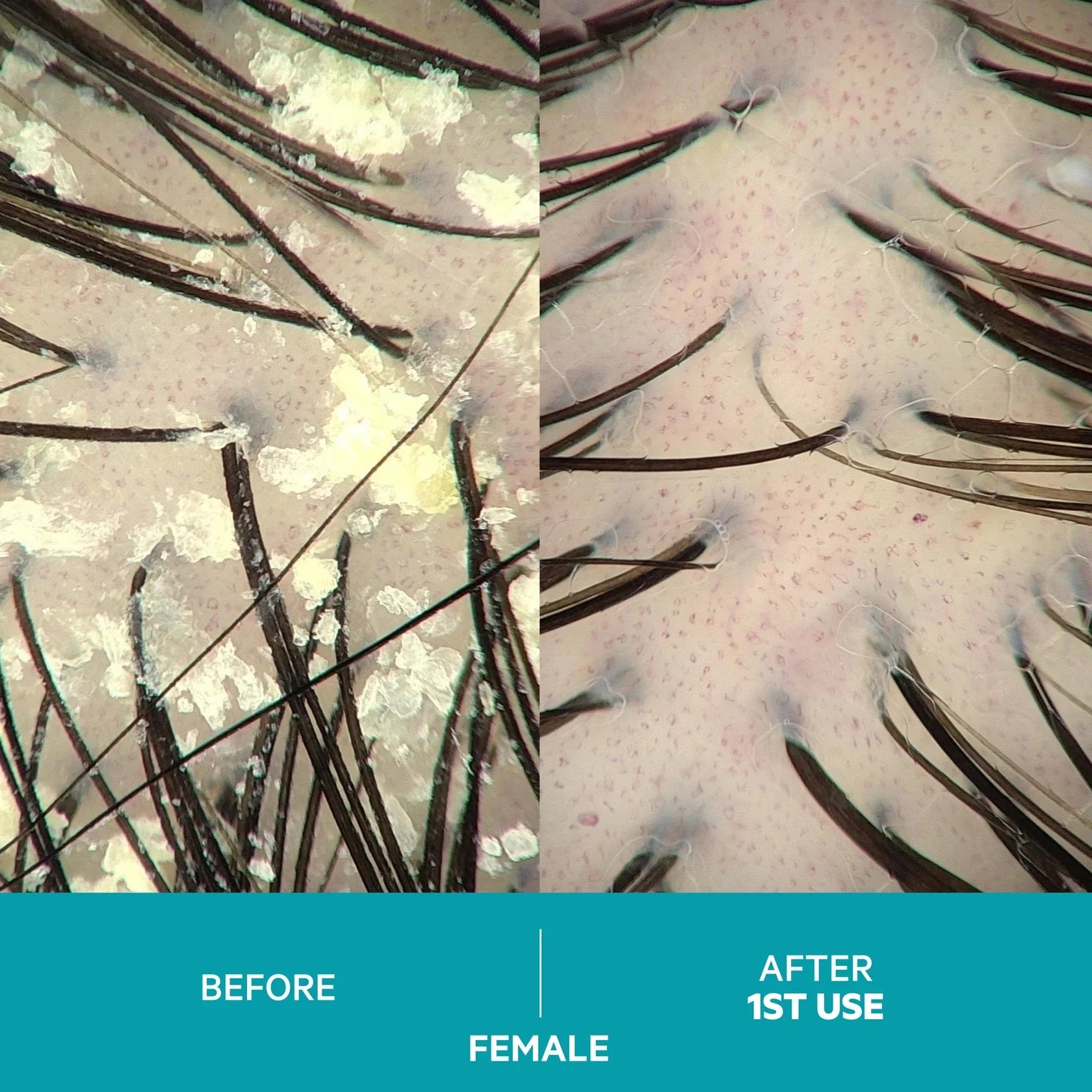 Dandrene Exfoliating Anti-Dandruff Shampoo by Monarch MD Medical Aesthetics