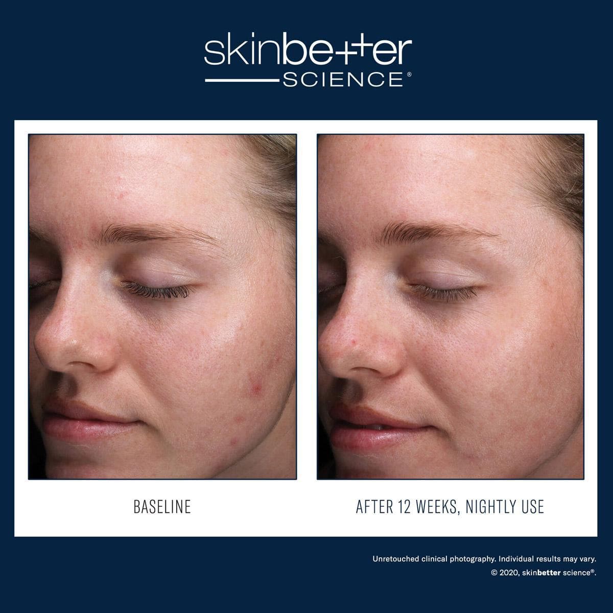 Skinbetter Science - AlphaRet Clearing Serum by Monarch MD Medical Aesthetics