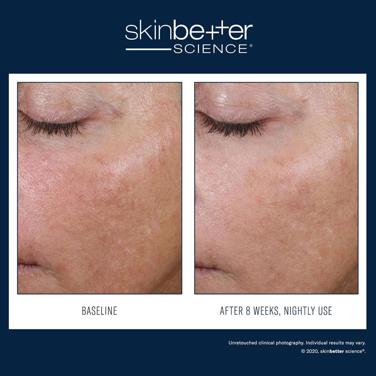 Skinbetter Science - AlphaRet Overnight Cream by Monarch MD Medical Aesthetics