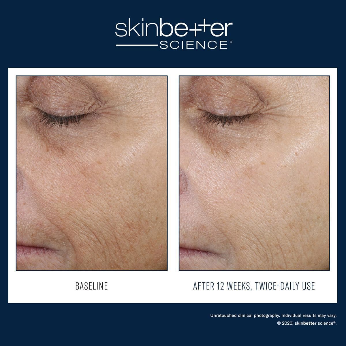 Skinbetter Science - Even Intensive Correcting Serum Face by Monarch MD Medical Aesthetics