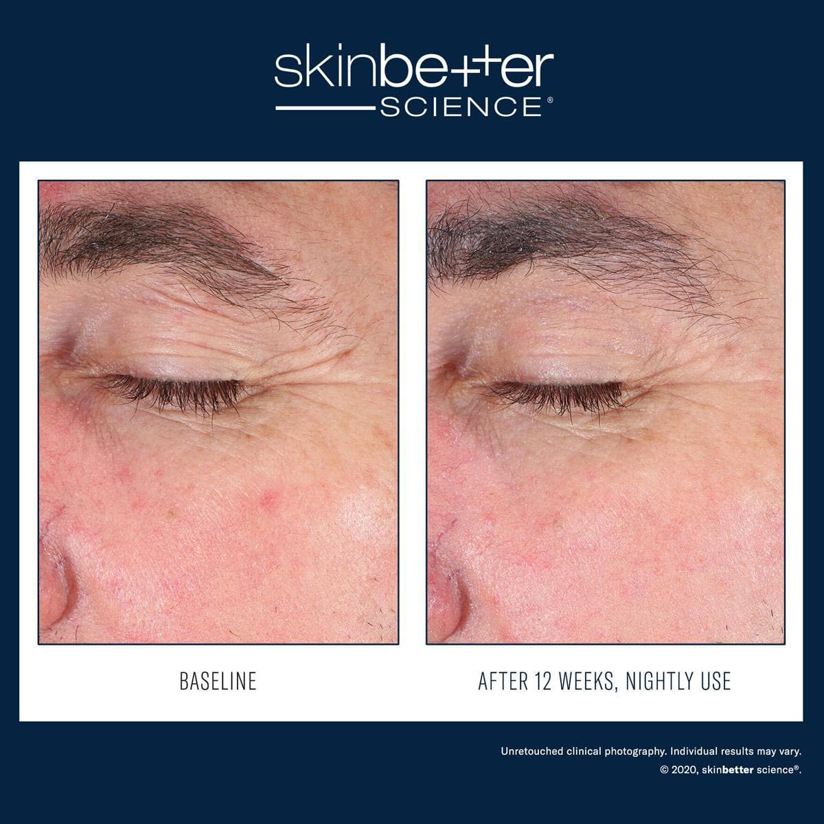 Skinbetter Science - EyeMax AlphaRet Overnight by Monarch MD Medical Aesthetics