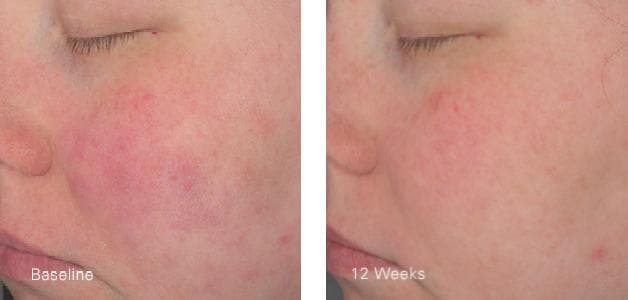 ZO Hydrating Creme by Monarch MD Medical Aesthetics