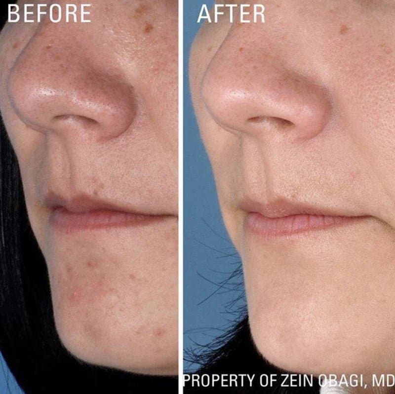 ZO Instant Pore Refiner by Monarch MD Medical Aesthetics