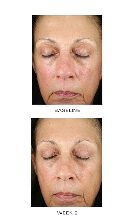 ZO Renewal Creme by Monarch MD Medical Aesthetics